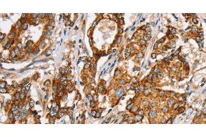 Immunohistochemistry of paraffin-embedded Human liver cancer tissue using SLC5A11 Polyclonal Antibody at dilution 1:35 (Solute Carrier Family 5 (Sodium/inositol Cotransporter), Member 11 (SLC5A11) 抗体)