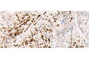 Immunohistochemistry of paraffin-embedded Human cervical cancer tissue using HLA-B Polyclonal Antibody at dilution of 1:30(x200) (HLA-B 抗体)