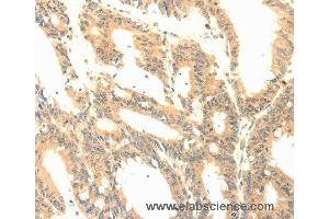 Immunohistochemistry of Human colon cancer using PTGES3 Polyclonal Antibody at dilution of 1:50
