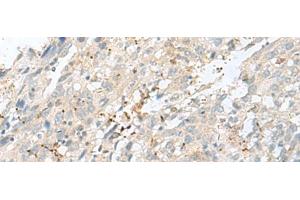 Immunohistochemistry of paraffin-embedded Human cervical cancer tissue using TPMT Polyclonal Antibody at dilution of 1:60(x200) (TPMT 抗体)