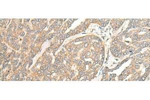 Immunohistochemistry of paraffin-embedded Human liver cancer tissue using ITM2B Polyclonal Antibody at dilution of 1:35(x200) (ITM2B 抗体)
