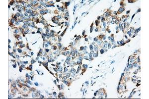 Immunohistochemical staining of paraffin-embedded Adenocarcinoma of Human colon tissue using anti-IGF2BP2 mouse monoclonal antibody. (IGF2BP2 抗体)