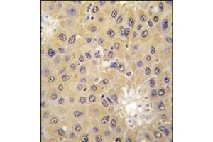 Formalin-fixed and paraffin-embedded human hepatocarcinoma tissue reacted with ACAT1 antibody (C-term), which was peroxidase-conjugated to the secondary antibody, followed by DAB staining. (ACAT1 抗体  (C-Term))