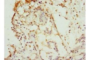 Immunohistochemistry of paraffin-embedded human breast cancer using ABIN7146875 at dilution of 1:100 (CSNK1G1 抗体  (Isoform gamma 1))