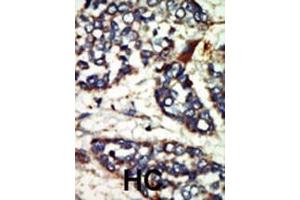 Formalin-fixed and paraffin-embedded human cancer tissue reacted with the primary antibody, which was peroxidase-conjugated to the secondary antibody, followed by DAB staining. (NEK1 抗体  (C-Term))