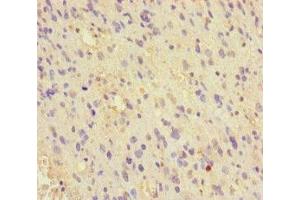 Immunohistochemistry of paraffin-embedded human glioma using ABIN7159738 at dilution of 1:100 (MCRS1 抗体  (AA 1-138))