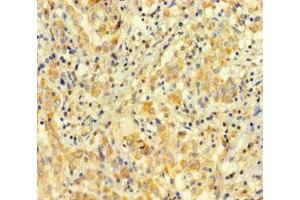 Immunohistochemistry of paraffin-embedded human lung cancer using ABIN7167948 at dilution of 1:100 (ARHGAP27 抗体  (AA 1-300))