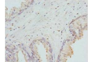 Immunohistochemistry of paraffin-embedded human prostate cancer using ABIN7155677 at dilution of 1:100 (DLX2 抗体  (AA 1-140))