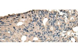 Immunohistochemistry of paraffin-embedded Human colorectal cancer tissue using SLAMF7 Polyclonal Antibody at dilution of 1:30(x200) (SLAMF7 抗体)