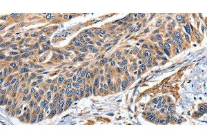 Immunohistochemistry of paraffin-embedded Human esophagus cancer tissue using EFNB2 Polyclonal Antibody at dilution 1:80 (Ephrin B2 抗体)