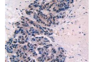 IHC-P analysis of Human Breast Cancer Tissue, with DAB staining. (Endoglin 抗体  (AA 26-136))