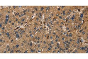 Immunohistochemistry of paraffin-embedded Human liver cancer tissue using UBE2S Polyclonal Antibody at dilution 1:40 (UBE2S 抗体)