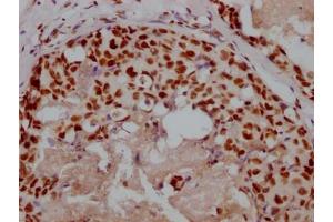 IHC image of ABIN7127596 diluted at 1:100 and staining in paraffin-embedded human breast cancer performed on a Leica BondTM system. (Recombinant XRCC5 抗体)