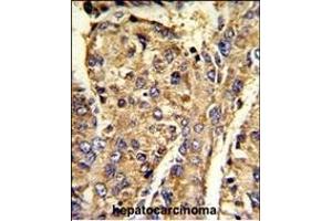 Formalin-fixed and paraffin-embedded human hepatocarcinoma reacted with HNRPL Antibody (C-term), which was peroxidase-conjugated to the secondary antibody, followed by DAB staining. (HNRNPL 抗体  (C-Term))