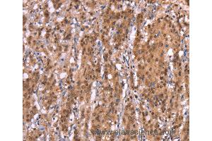 Immunohistochemistry of Human thyroid cancer using AMER1 Polyclonal Antibody at dilution of 1:40 (WTX 抗体)