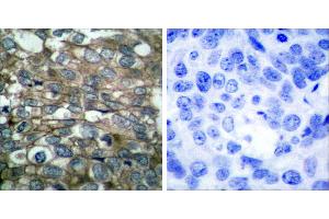 Peptide - +Immunohistochemical analysis of paraffin-embedded human breast carcinoma tissue using EGFR (Ab-869) antibody (#B7065). (EGFR 抗体  (Tyr869))