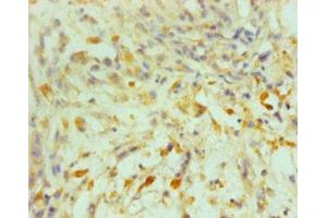 Immunohistochemistry of paraffin-embedded human melanoma using ABIN7164069 at dilution of 1:100 (OCT4 抗体  (AA 1-360))