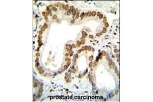 BTG2 Antibody (N-term) (ABIN654080 and ABIN2843972) immunohistochemistry analysis in formalin fixed and paraffin embedded human prostate carcinoma followed by peroxidase conjugation of the secondary antibody and DAB staining. (BTG2 抗体  (N-Term))