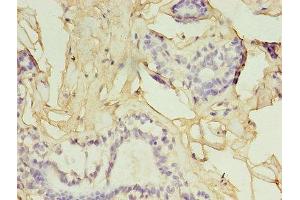 Immunohistochemistry of paraffin-embedded human breast cancer using ABIN7153819 at dilution of 1:100 (GGPS1 抗体  (AA 1-300))