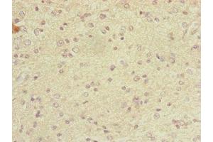 Immunohistochemistry of paraffin-embedded human glioma using ABIN7149326 at dilution of 1:100 (DYNC2LI1 抗体  (AA 1-352))