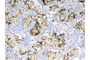 IHC testing of FFPE human breast cancer tissue with GALE antibody at 1ug/ml. (GALE 抗体)