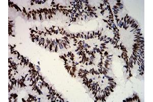 Immunohistochemical analysis of paraffin-embedded colon cancer tissues using ESR1 mouse mAb with DAB staining. (Estrogen Receptor alpha 抗体  (AA 2-185))