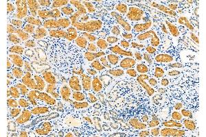 ABIN6260014 and ABIN6279139 at 1/100 staining Human kidney cancer and adjacent normal tissues by IHC-P.