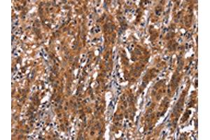 The image on the left is immunohistochemistry of paraffin-embedded Human gastric cancer tissue using ABIN7190842(GPHN Antibody) at dilution 1/30, on the right is treated with synthetic peptide. (Gephyrin 抗体)