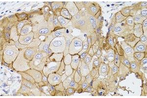 Immunohistochemistry of paraffin-embedded Human breast cancer using PDE4D Polyclonal Antibody at dilution of 1:100 (40x lens). (PDE4D 抗体)