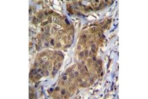 Formalin fixed, paraffin embedded human breast carcinoma stained with RNF11 Antibody (Center) followed by peroxidase conjugation of the secondary antibody and DAB staining (RNF11 抗体  (Middle Region))