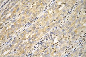 Immunohistochemistry was performed on paraffin-embedded human breast carcinoma using keratin 18 antibody (ABIN7799174), 1:200).