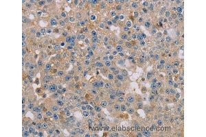 Immunohistochemistry of Human breast cancer using CLIC1 Polyclonal Antibody at dilution of 1:30 (CLIC1 抗体)