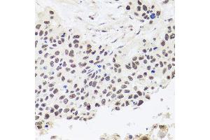 Immunohistochemistry of paraffin-embedded human lung cancer using RPP30 antibody (ABIN5974603) at dilution of 1/100 (40x lens). (RPP30 抗体)