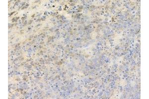 ABIN6256017 and ABIN6267403 at 1/100 staining human melanoma by IHC-P.
