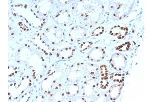 Formalin-fixed, paraffin-embedded human Renal Cell Carcinoma stained with PAX8 Mouse Monoclonal Antibody (PAX8/1492). (PAX8 抗体  (AA 60-261))