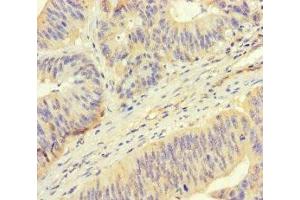 Immunohistochemistry of paraffin-embedded human colon cancer using ABIN7168424 at dilution of 1:100 (ROPN1 抗体  (AA 1-212))
