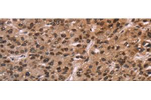Immunohistochemistry of paraffin-embedded Human liver cancer tissue using LMNB1 Polyclonal Antibody at dilution of 1:60(x200) (Lamin B1 抗体)