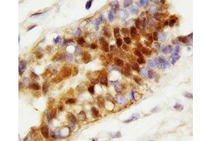 IHC-P: Hsc70 antibody testing of human breast cancer tissue (Hsc70 抗体  (N-Term))