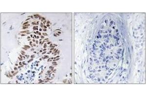 Immunohistochemistry analysis of paraffin-embedded human lung carcinoma tissue, using DAPK3 (Ab-265) Antibody. (DAPK3 抗体  (AA 241-290))