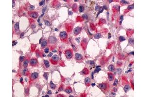 Anti-GPR64 antibody IHC of human Skin, Melanoma. (Adhesion G-Protein Coupled Receptor G2 (ADGRG2) (C-Term) 抗体)