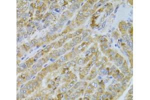 Immunohistochemistry of paraffin-embedded Human thyroid cancer using DLD Polyclonal Antibody at dilution of 1:100 (40x lens). (DLD 抗体)