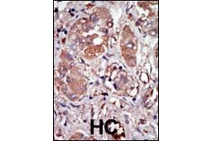 Immunohistochemistry (Paraffin-embedded Sections) (IHC (p)) image for anti-Eukaryotic Translation Initiation Factor 2-alpha Kinase 2 (EIF2AK2) (AA 519-550), (C-Term) antibody (ABIN392779)