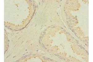 Immunohistochemistry of paraffin-embedded human prostate cancer using ABIN7174924 at dilution of 1:100 (CXorf21 抗体  (AA 1-301))