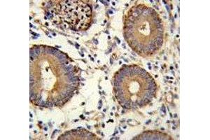 CEA antibody immunohistochemistry analysis in formalin fixed and paraffin embedded human colon carcinoma.