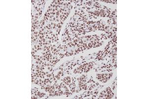 Immunohistochemical analysis of A on paraffin-embedded Human breast carcinoma tissue. (ERBB4 抗体  (pTyr1188))