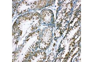 IHC-P: HSP10 antibody testing of human intestinal cancer tissue (HSPE1 抗体  (C-Term))
