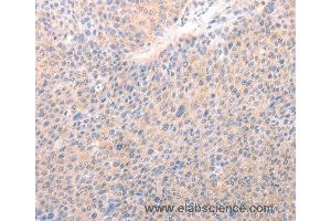 Immunohistochemistry of Human lung cancer using ACO1 Polyclonal Antibody at dilution of 1:50 (Aconitase 1 抗体)