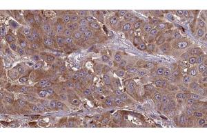 ABIN6273643 at 1/100 staining Human liver cancer tissue by IHC-P. (IFITM1 抗体  (N-Term))