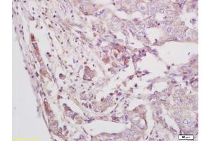Formalin-fixed and paraffin embedded human breast carcinoma labeled with Anti-Phospho-BMX/ETK (Tyr556) Polyclonal Antibody, Unconjugated (ABIN756667) at 1:200 followed by conjugation to the secondary antibody and DAB staining
