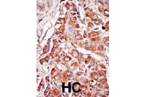 Formalin-fixed and paraffin-embedded human hepatocellular carcinoma tissue reacted with EIF2AK2 polyclonal antibody  , which was peroxidase-conjugated to the secondary antibody, followed by DAB staining. (EIF2AK2 抗体  (N-Term))